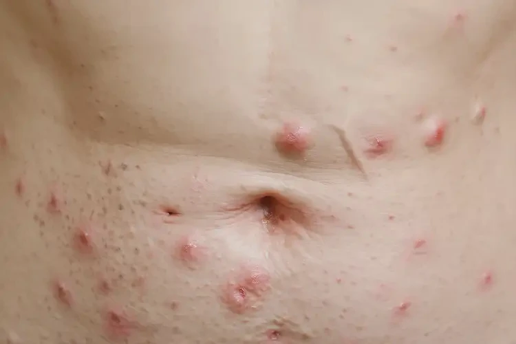 女性肚子上出濕疹可以徹底自愈嗎(圖4)