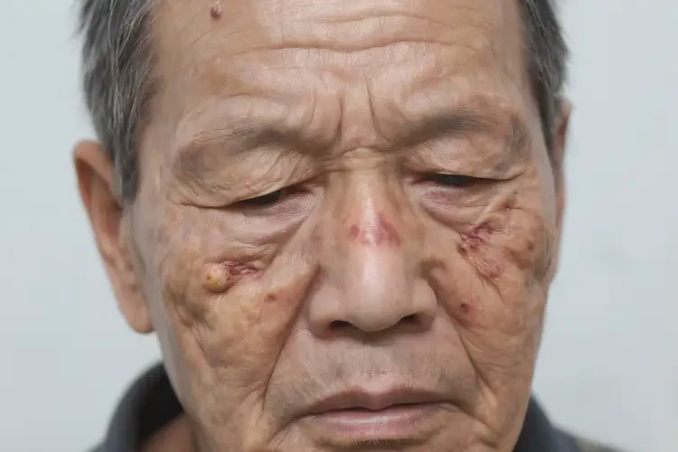 老年人臉上容易起濕疹能徹底自愈嗎(圖4)