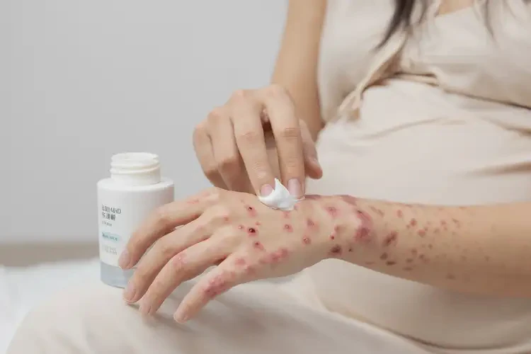 產(chǎn)婦手上起濕疹能夠徹底治愈嗎(圖3)