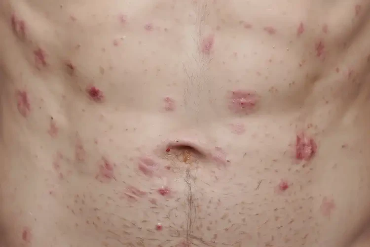 青年人肚子出濕疹不管它會自己好嗎(圖4)