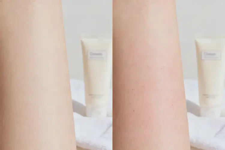 女人身上起濕疹不管它會自己痊愈嗎(圖2)