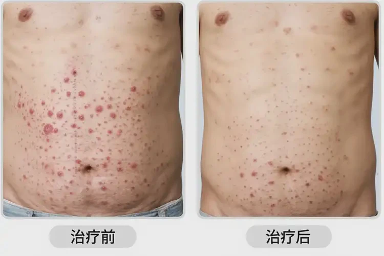 老人肚子上偶爾長濕疹不管它會自己痊愈嗎(圖2)