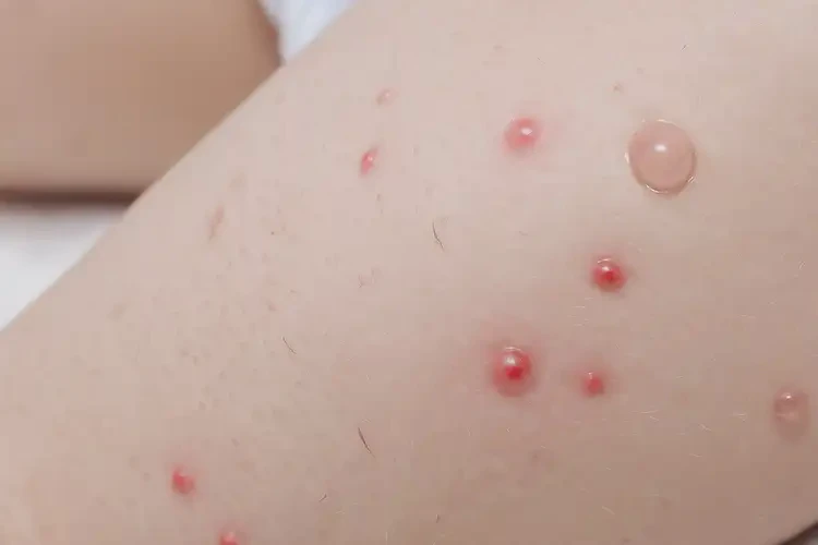 幼兒大腿經(jīng)常起濕疹能徹底自愈嗎(圖4)