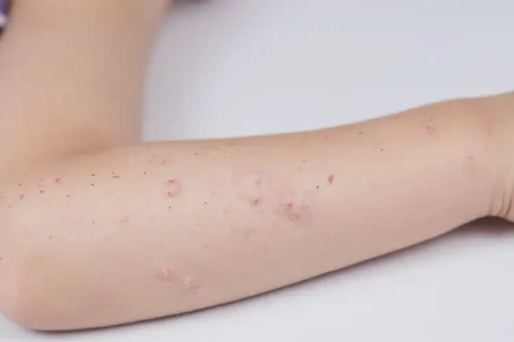 小兒手臂偶爾長濕疹可以徹底自愈嗎(圖4)
