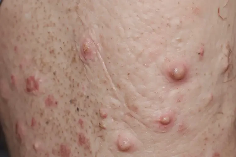 男人四肢容易起湿疹能彻底自愈吗(图4)