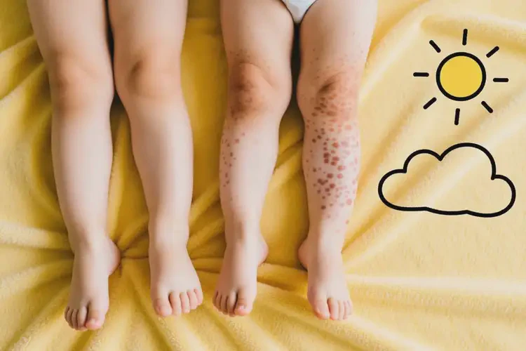 小兒大腿容易長濕疹能靠自己自愈嗎(圖1)