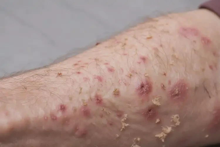 高齡老人手臂上容易長(zhǎng)濕疹可以徹底自愈嗎(圖4)