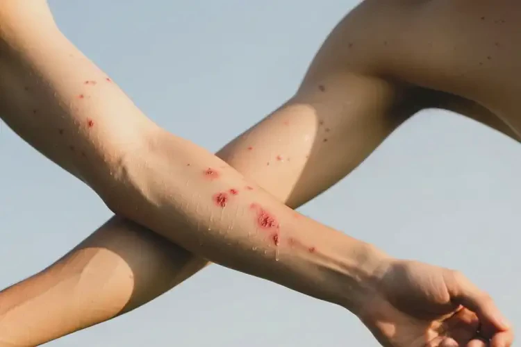 男生身上偶爾起濕疹不管它會自己好嗎(圖3)