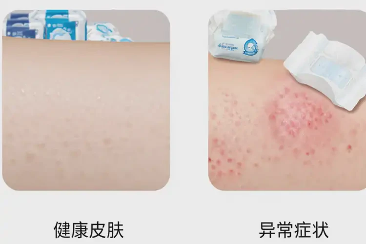 婴幼儿肛周容易长湿疹能靠自己自愈吗(图1)