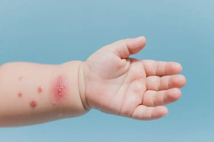 嬰兒手臂上容易長濕疹可以徹底自愈嗎(圖1)