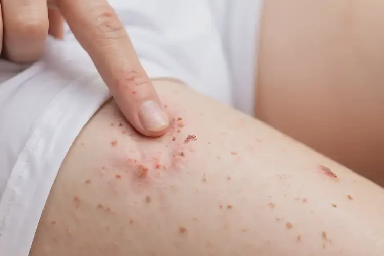 孕婦小腿上出現(xiàn)濕疹能徹底自愈嗎(圖4)