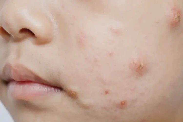 中学生脸上容易长湿疹可不可以彻底自愈(图3)