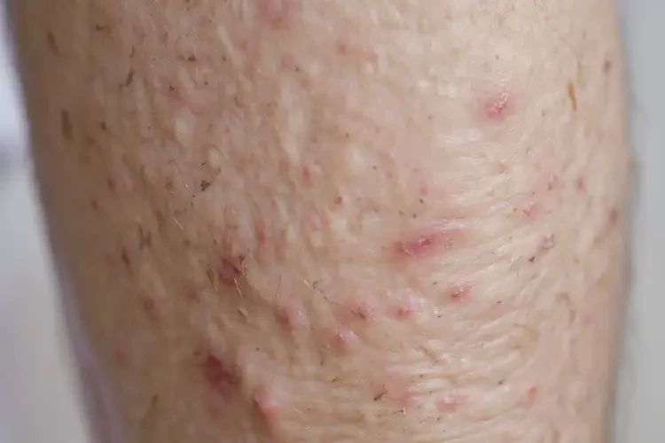 高齡老人小腿上長濕疹能不能徹底自愈(圖4)