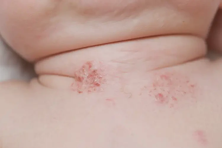 新生兒脖子上經(jīng)常長濕疹可不可以徹底自愈(圖4)