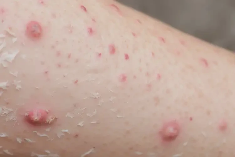 女性手臂容易起濕疹可以徹底自愈嗎(圖4)