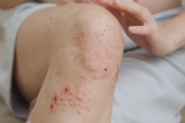 孕婦大腿有濕疹能靠自己自愈嗎(圖4)