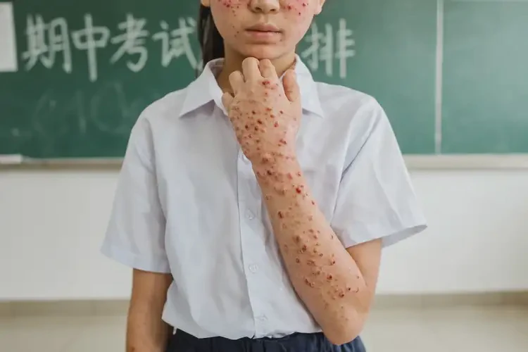 中學生四肢偶爾起濕疹不管它會自己好嗎(圖3)