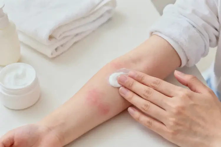 少兒手臂經(jīng)常起濕疹能靠自己自愈嗎(圖2)