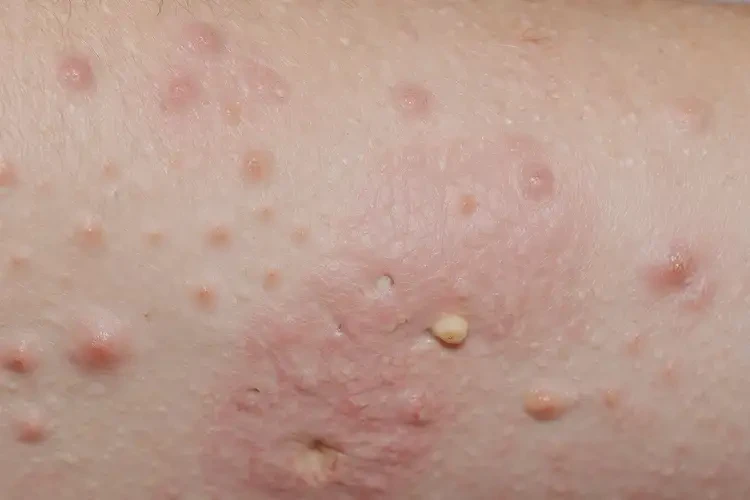 大学生屁股出湿疹不管它会自己自愈吗(图3)