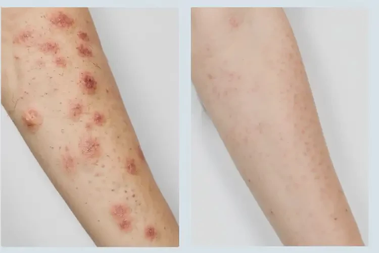 女性手臂容易起濕疹可以徹底自愈嗎(圖1)