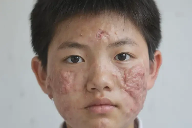 中学生脸上容易长湿疹可不可以彻底自愈(图2)