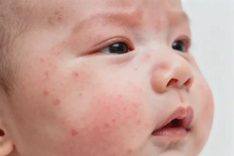 新生兒臉上出濕疹可以徹底自愈嗎(圖1)
