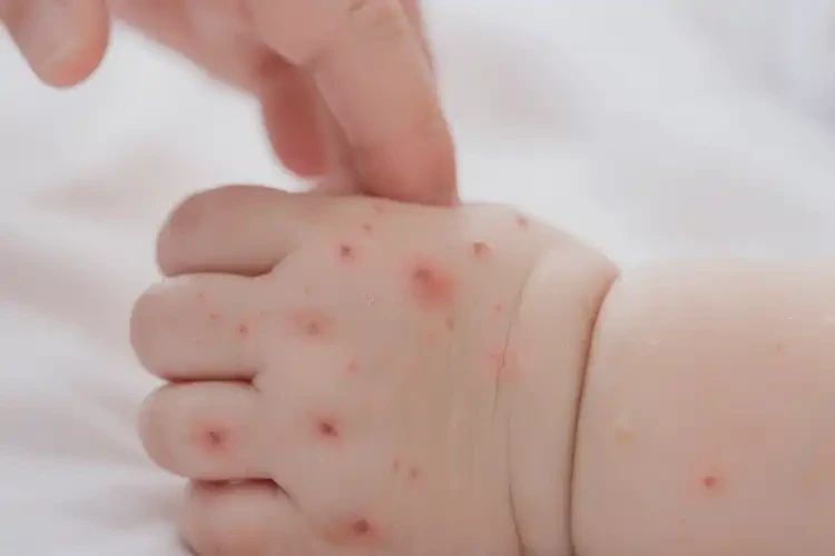 婴儿手上偶尔起湿疹能彻底自愈吗(图4)