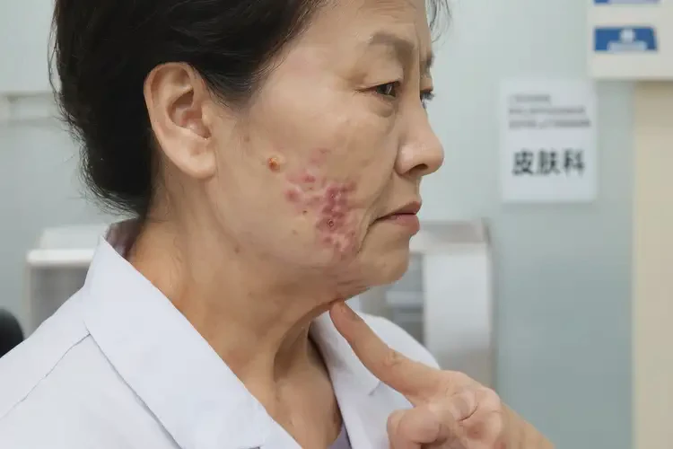 女生脖子上長濕疹可不可以徹底自愈(圖4)