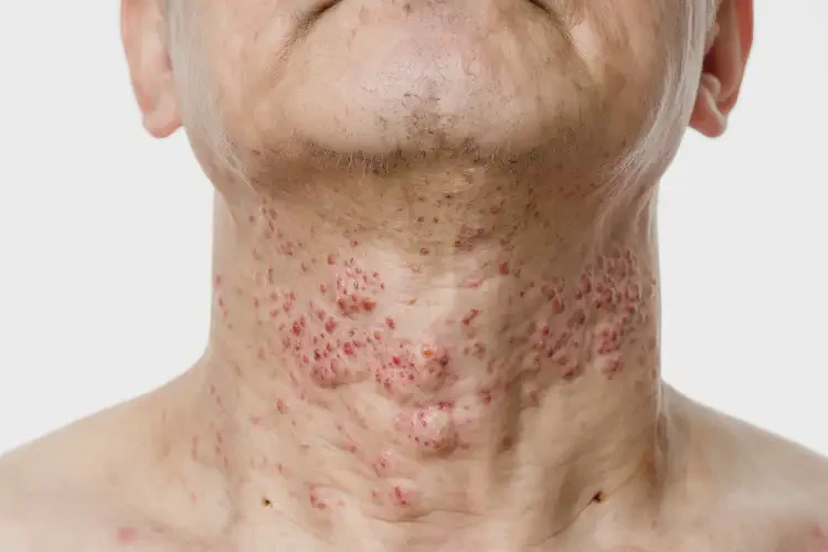 青年人脖子上出濕疹不管它會(huì)自己好嗎(圖1)