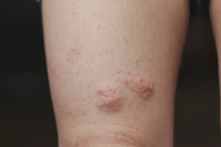 兒童大腿偶爾長濕疹不管它會(huì)自己痊愈嗎(圖4)