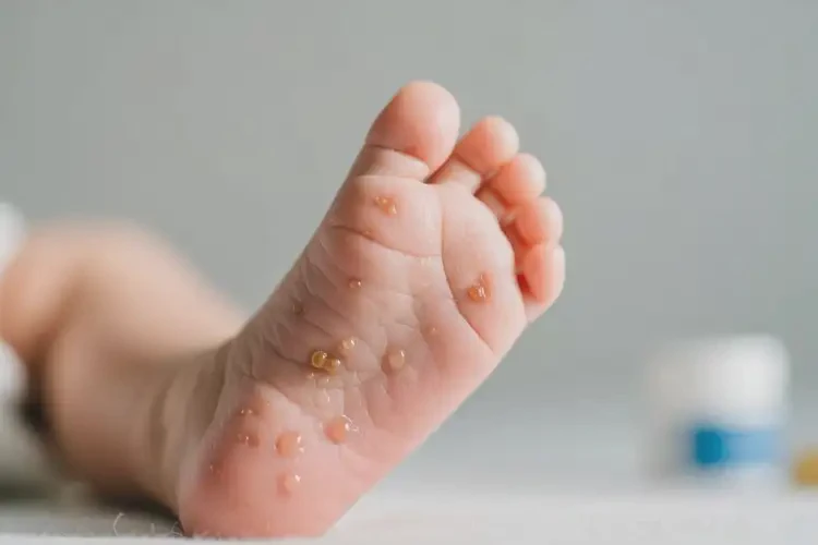 新生兒腳上偶爾長(zhǎng)濕疹能靠自己自愈嗎(圖2)