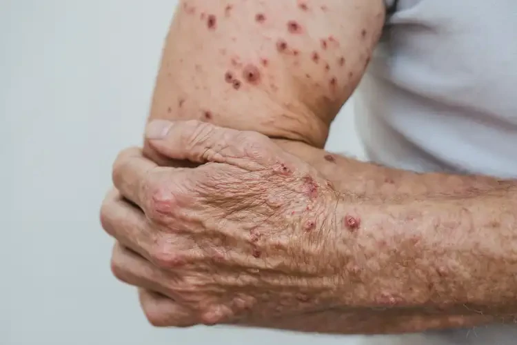 老年人手臂上經(jīng)常長濕疹能徹底自愈嗎(圖4)