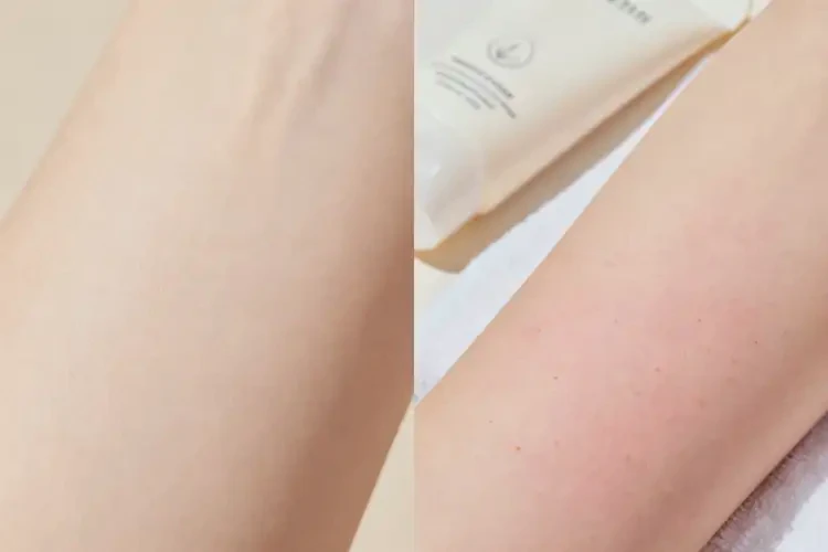 女人身上起濕疹不管它會自己痊愈嗎(圖1)