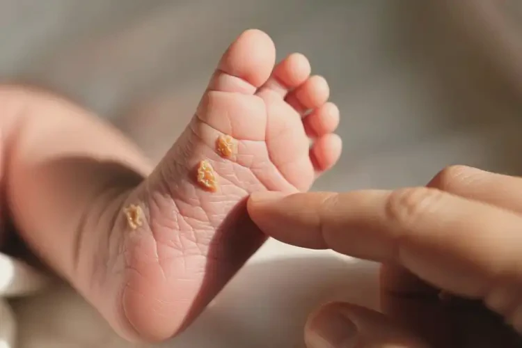 新生兒腳上出濕疹不管它會自己痊愈嗎(圖2)