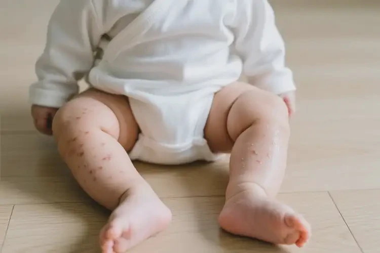 新生儿小腿上容易长湿疹不管它会自己自愈吗(图2)