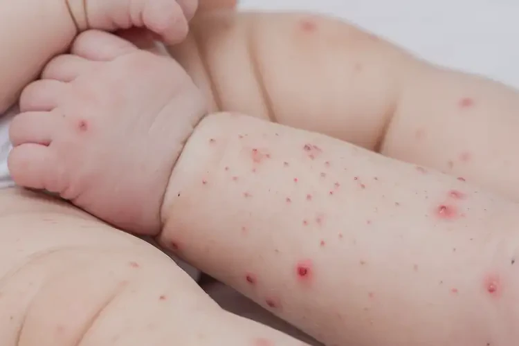 嬰幼兒四肢經(jīng)常長(zhǎng)濕疹能夠徹底治愈嗎(圖4)