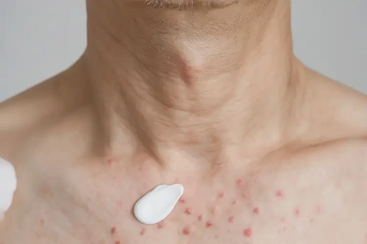 男性脖子偶尔起湿疹能靠自己自愈吗(图2)