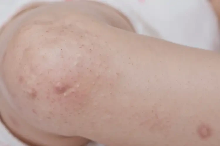 寶寶大腿上容易起濕疹可不可以徹底自愈(圖4)