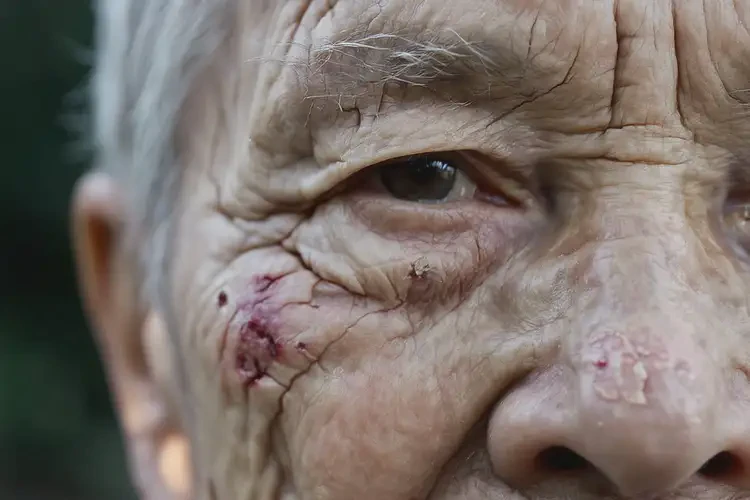 老年人四肢出濕疹不管它會(huì)自己痊愈嗎(圖4)