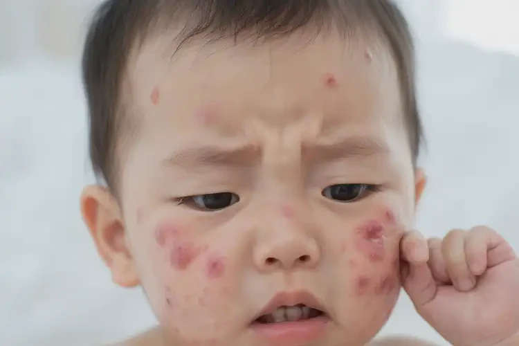 嬰幼兒臉上偶爾長濕疹能夠徹底治愈嗎(圖4)