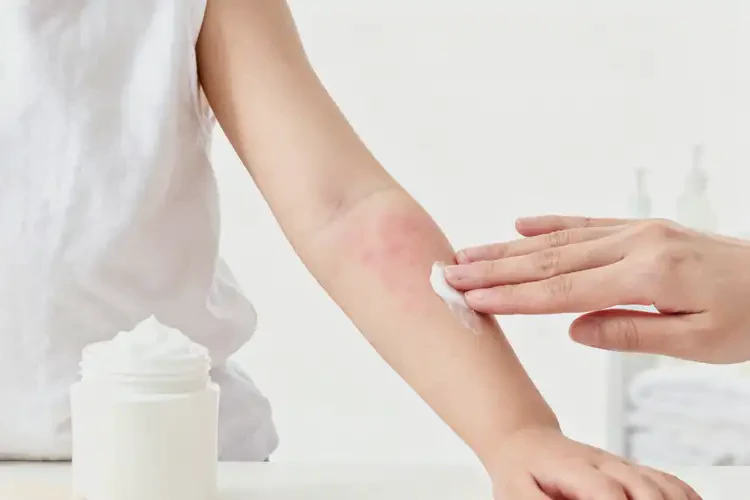 少兒手臂經(jīng)常起濕疹能靠自己自愈嗎(圖3)