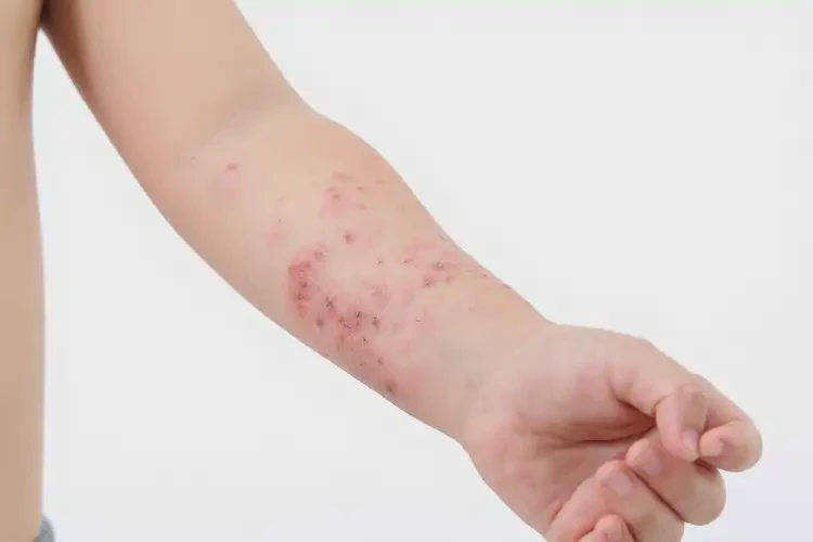 小孩手臂上出现湿疹不管它会自己自愈吗(图1)