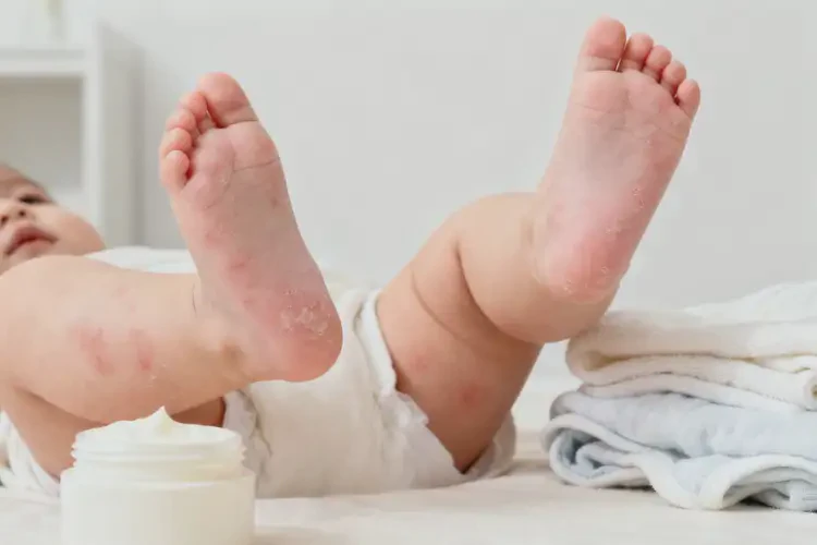 小儿四肢起湿疹可不可以彻底自愈(图3)