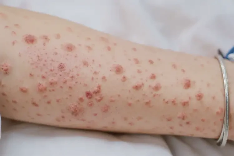 產(chǎn)婦手臂起濕疹能靠自己自愈嗎(圖3)