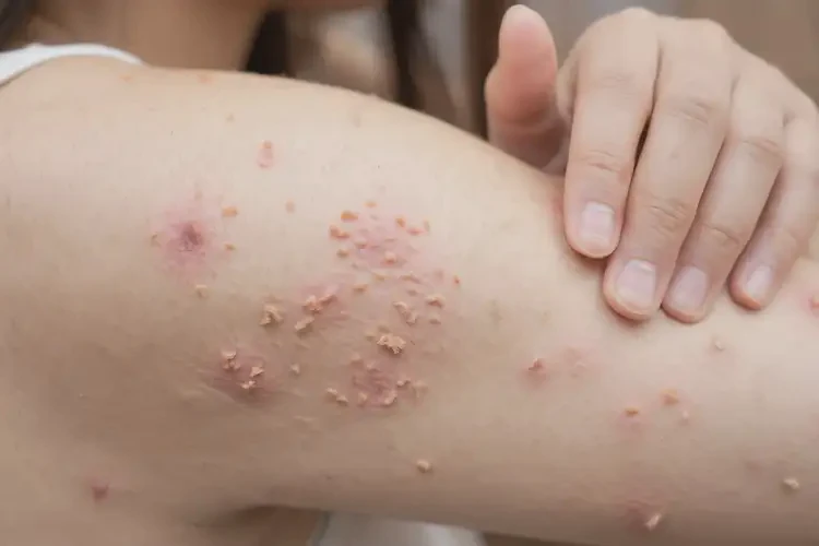 女生手臂有湿疹能彻底自愈吗(图4)