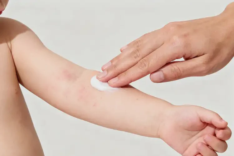 小兒手臂上偶爾起濕疹不管它會(huì)自己自愈嗎(圖1)