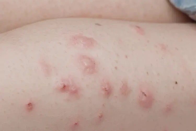 兒童小腿上偶爾長(zhǎng)濕疹可以徹底自愈嗎(圖4)