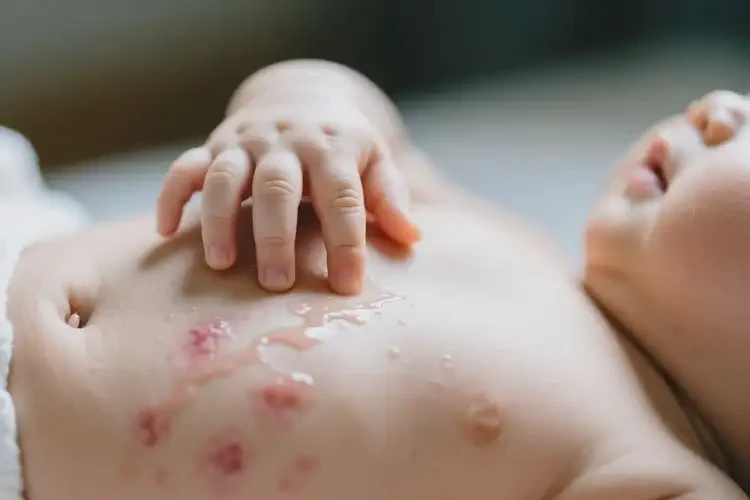 新生儿肚子经常长湿疹不管它会自己痊愈吗(图3)