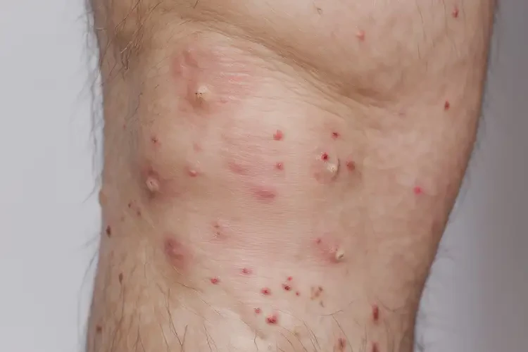 男性小腿經(jīng)常起濕疹不管它會自己好嗎(圖4)