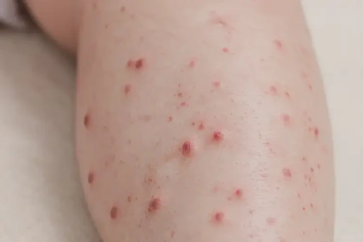幼兒小腿上起濕疹能靠自己自愈嗎(圖3)